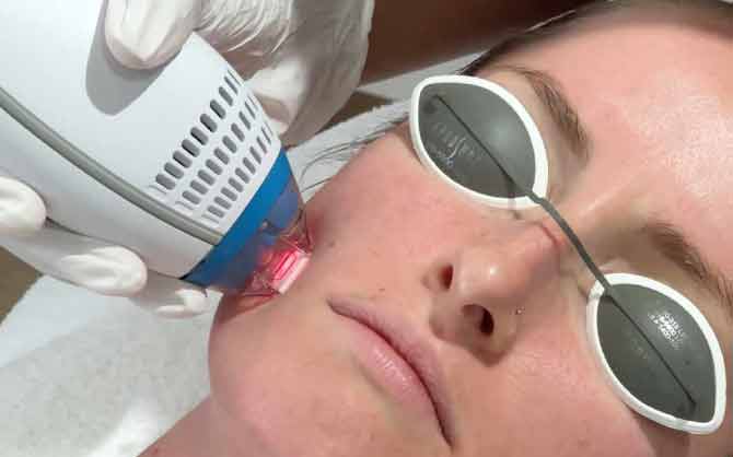 Clear + Brilliant Laser Facial image