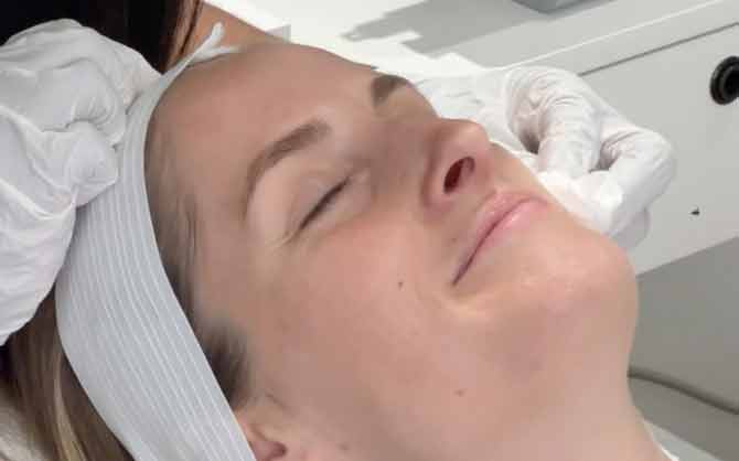 Lumecca IPL Photofacial image