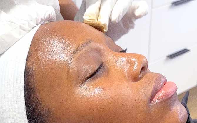 VI Peel image